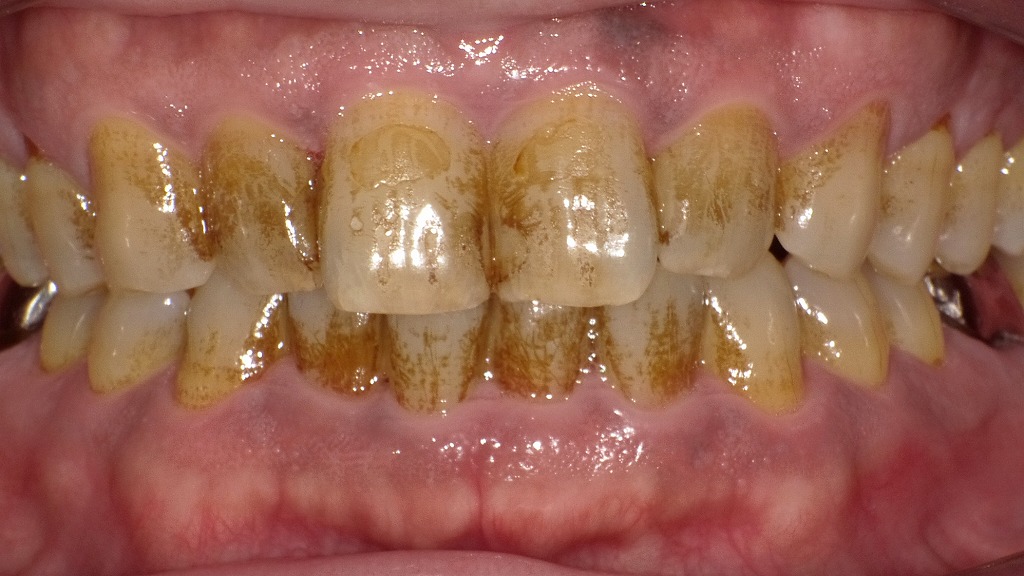 ステイン（着色汚れ）