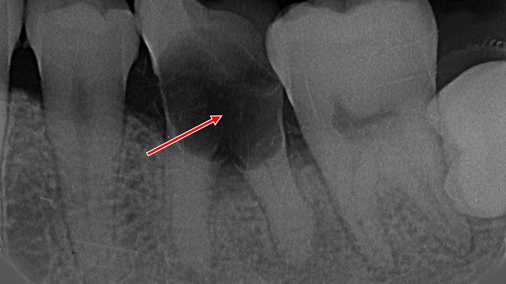 同症例下顎6番の重度虫歯 ― 抜歯に至ったレントゲン所見