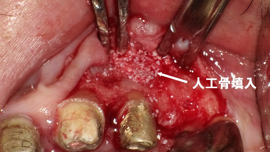 歯根端切除術と逆根充後に人工骨を填入