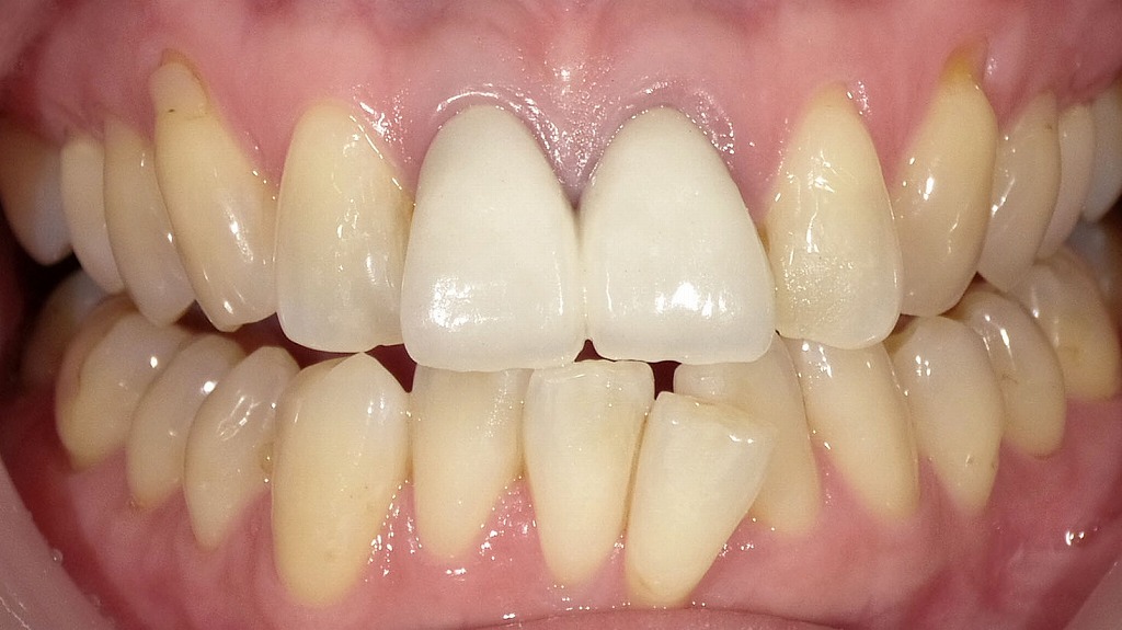 前歯破折をメタルボンドクラウンで修復した症例