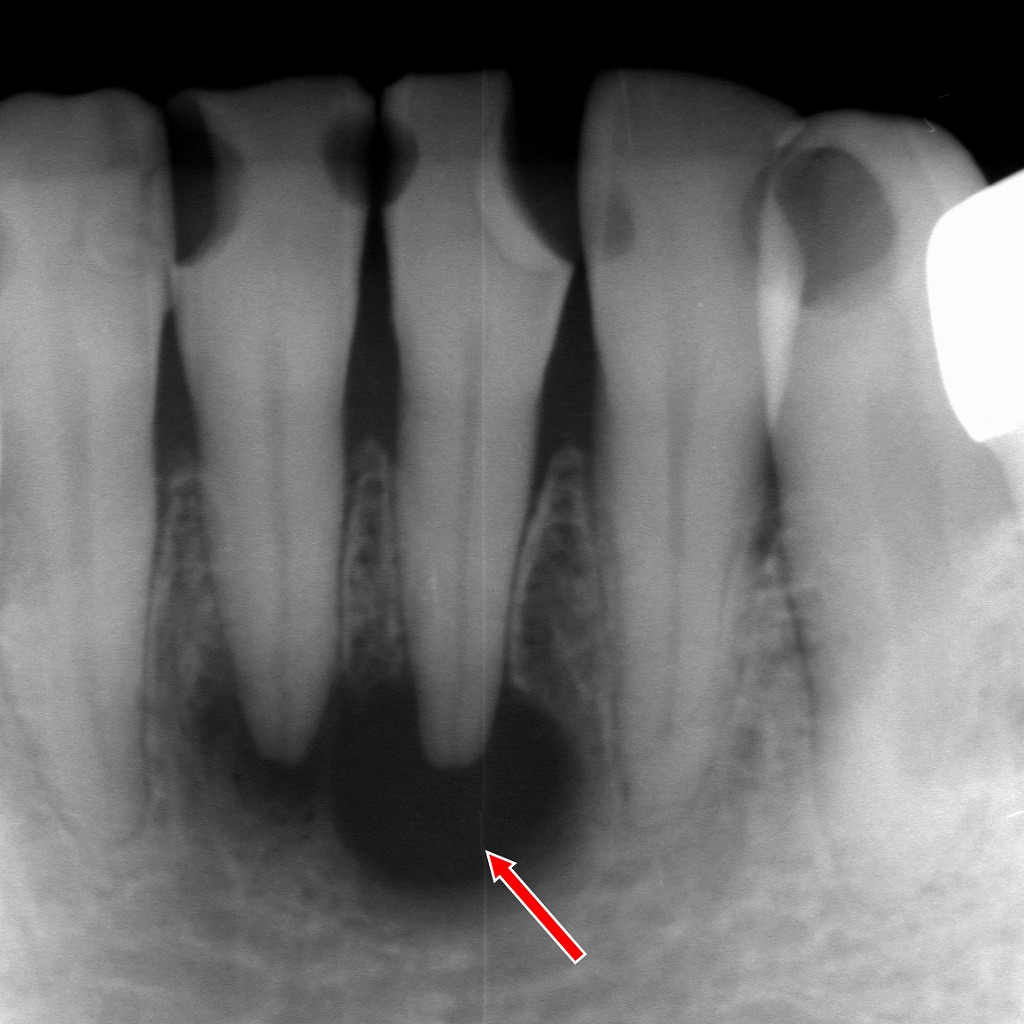 下顎左右1番を原因歯とする歯根嚢胞