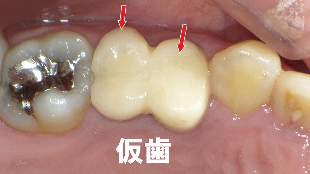 最終補綴前の仮歯(テンポラリークラウン)
