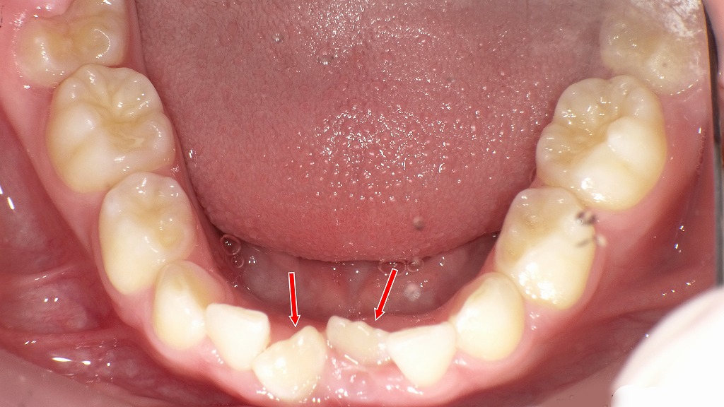 6歳児の下顎前歯部がガタガタ