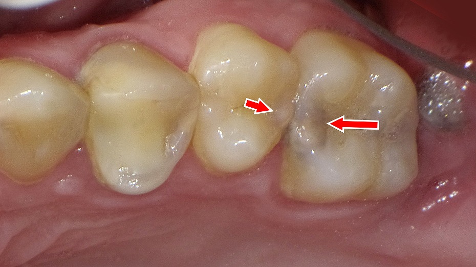 見た目は小さな変色でも、象牙質内部で広がる隣接面カリエス。フロス不足が原因に