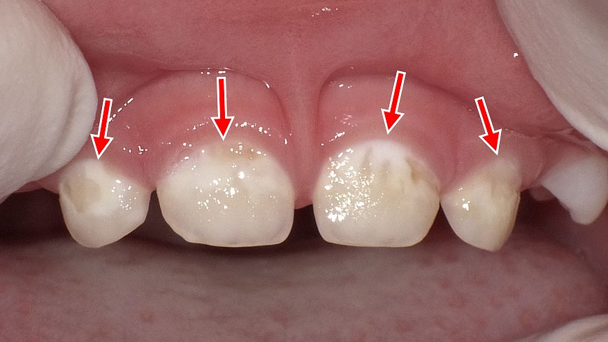 3歳児に見られる初期虫歯とプラークの付着