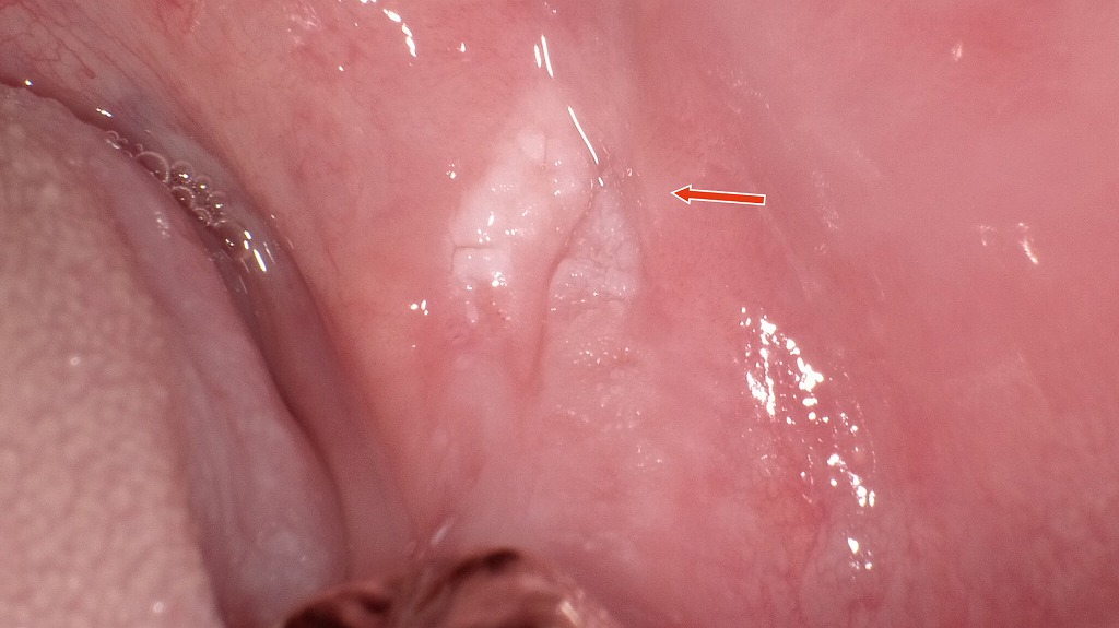下顎臼歯部の頬粘膜に見られる白板症