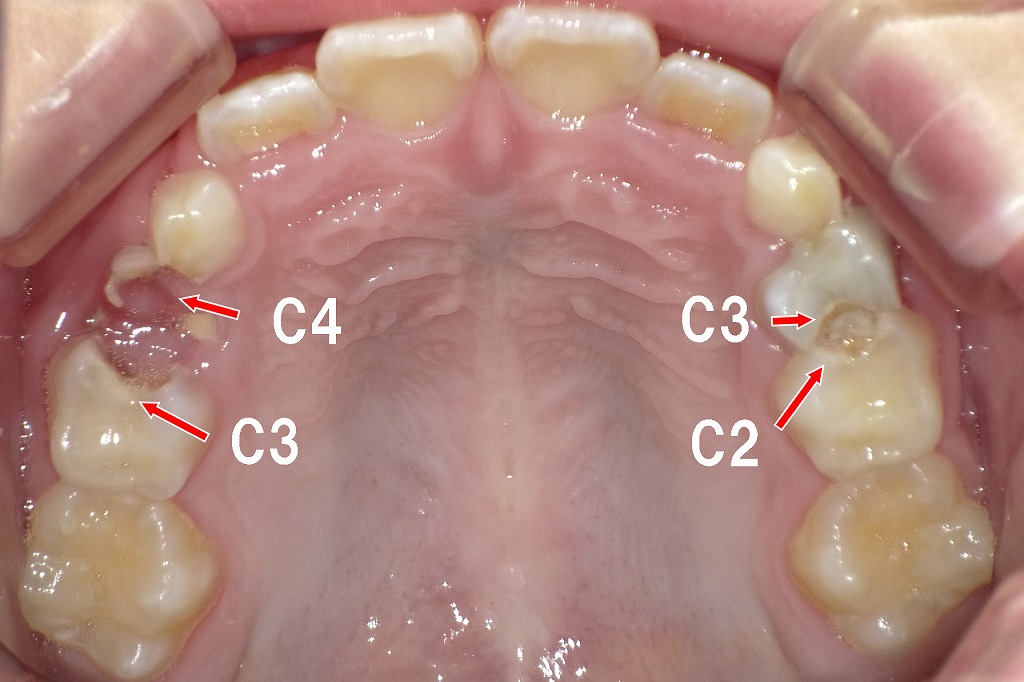 乳歯にC2〜C4の虫歯が多発