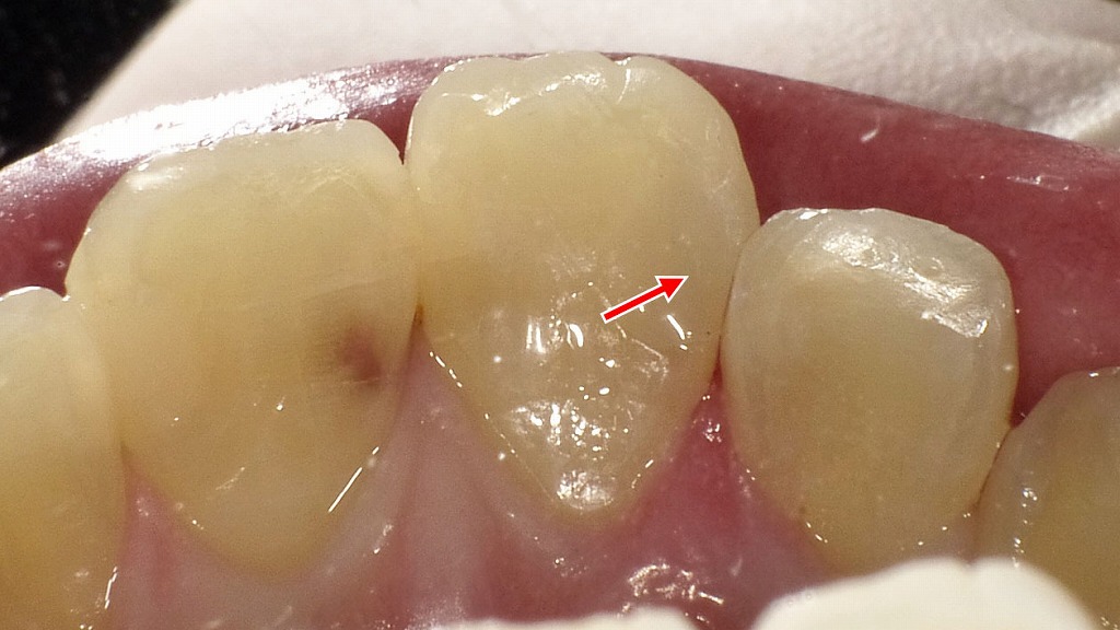 上顎1番C2虫歯をコンポジットレジンで修復した状態