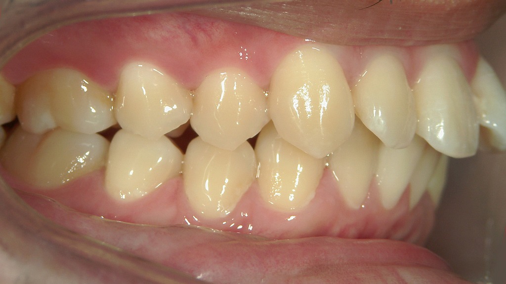口腔機能の発達がうまくいかないと、舌の位置や口呼吸の影響で前歯が前に押し出され、出っ歯になりやすくなります。
