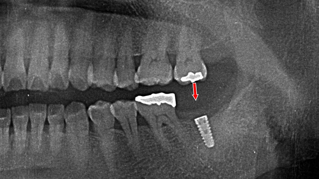 下顎7番抜歯後のインプラント埋入後レントゲン所見
