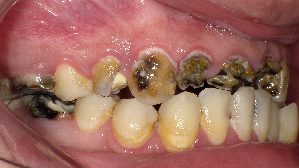 黒く変色した重度の虫歯｜長期間放置された進行例