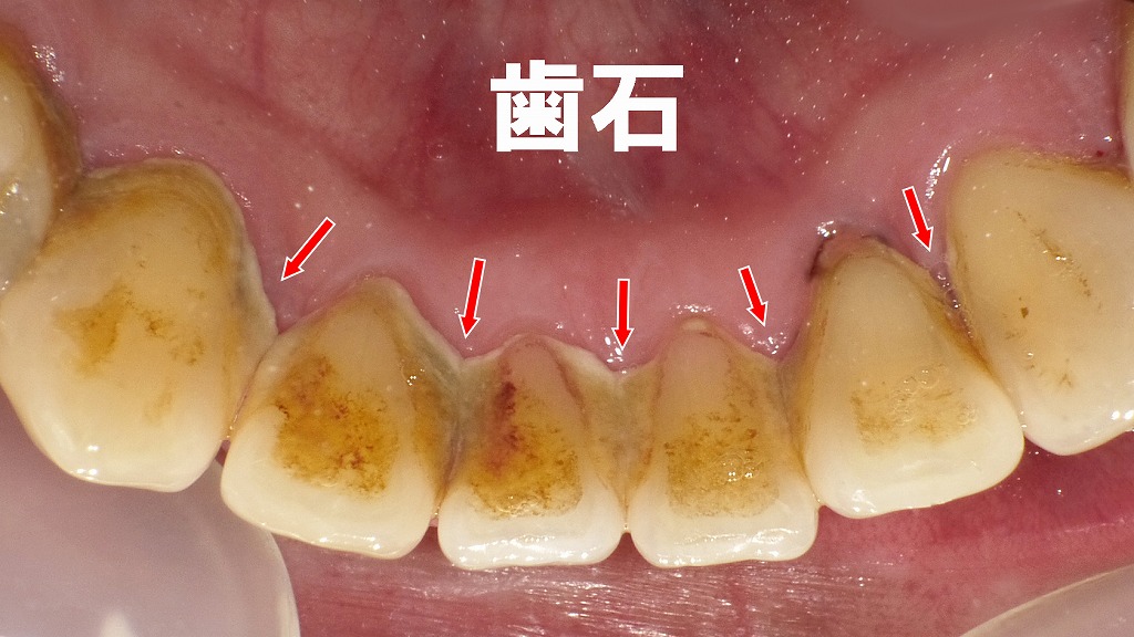 赤い矢印が示す部分に、プラークが石灰化した黄褐色の歯石が広く沈着しています。歯石は自分では取れないため、歯科医院での専門的なクリーニングが必要です。