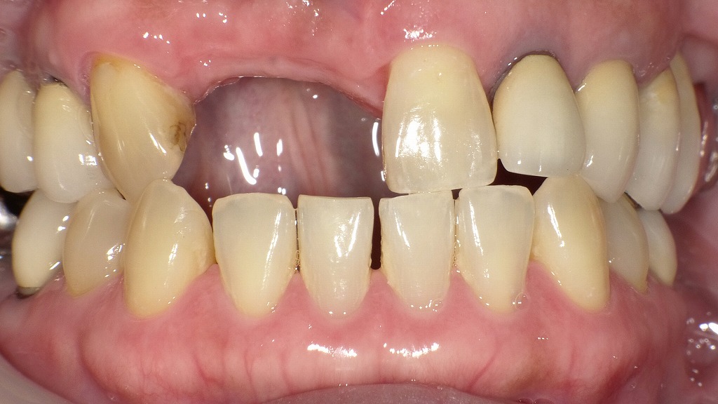 右上の中切歯(1番)と側切歯(2番)の欠損