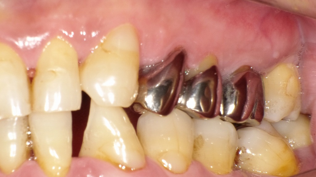 保険適用の銀歯（金属冠）