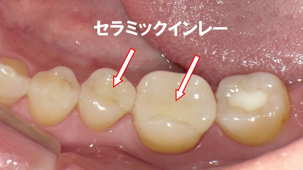 セラミックインレーの症例