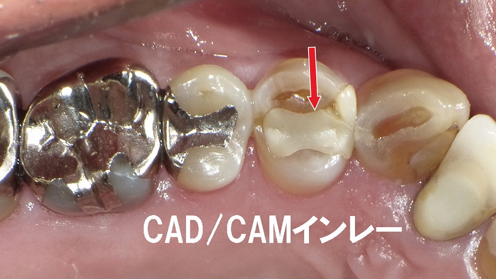 CAD/CAMインレー