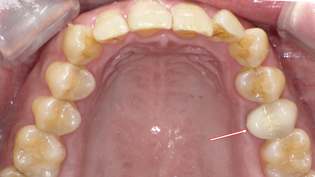 フルジルコニアクラウンの症例