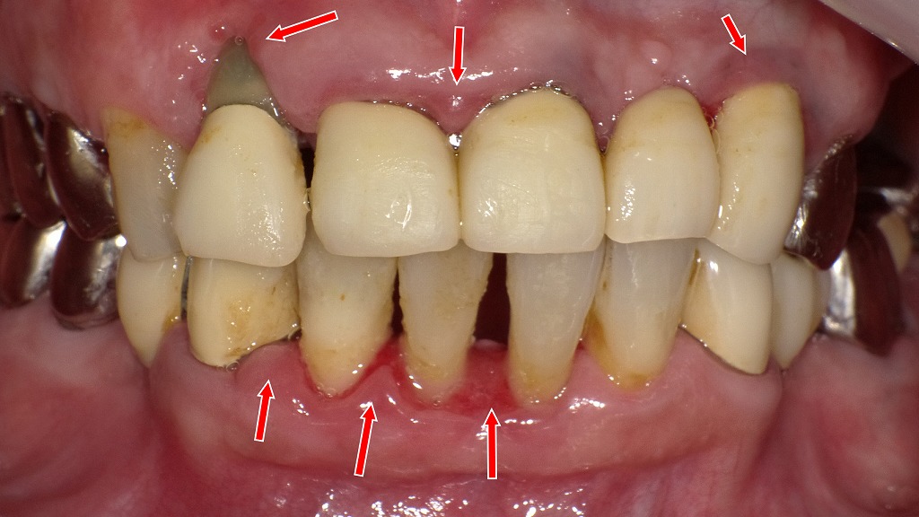 矢印部に歯ぐきの強い炎症があり、X線では歯槽骨の吸収が確認できる中程度の歯周病の状態です。