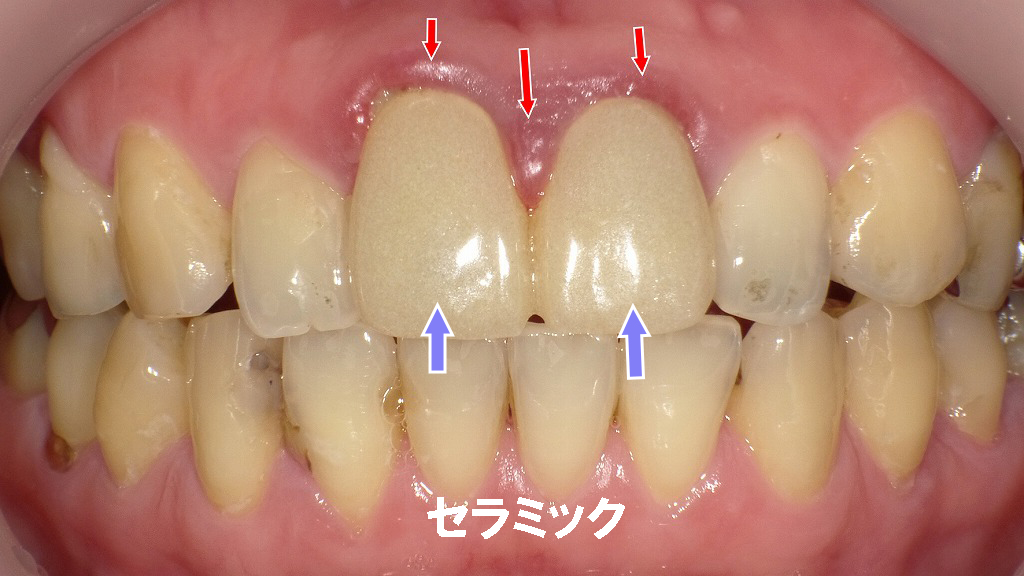 セラミックの間に汚れが溜まり、歯ぐきが赤く腫れた状態