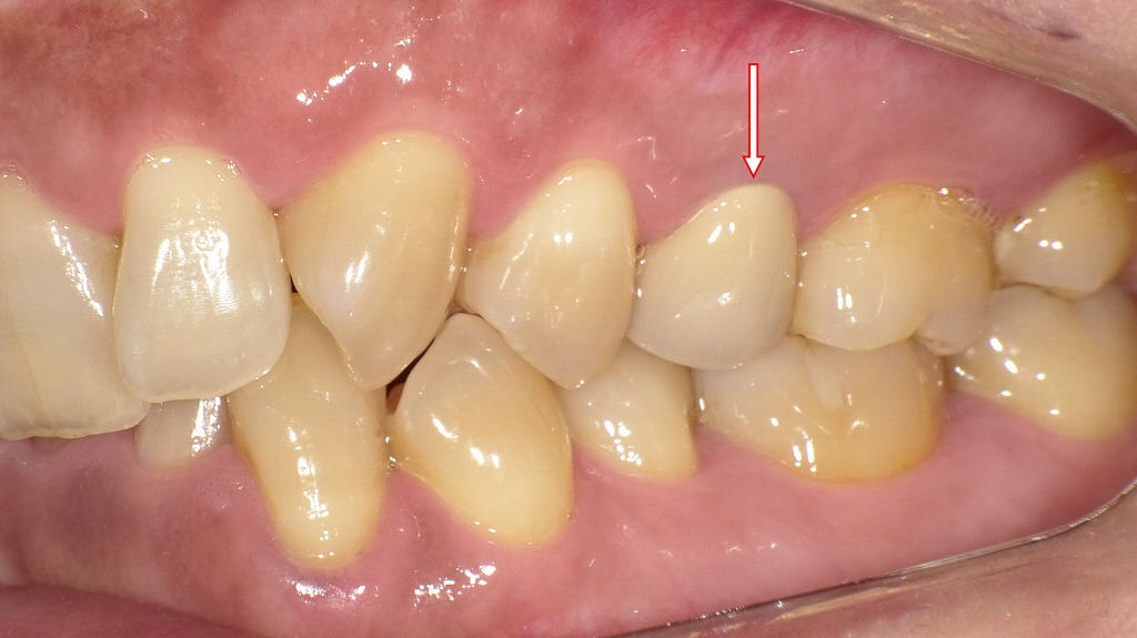 ジルコニアセラミッククラウン