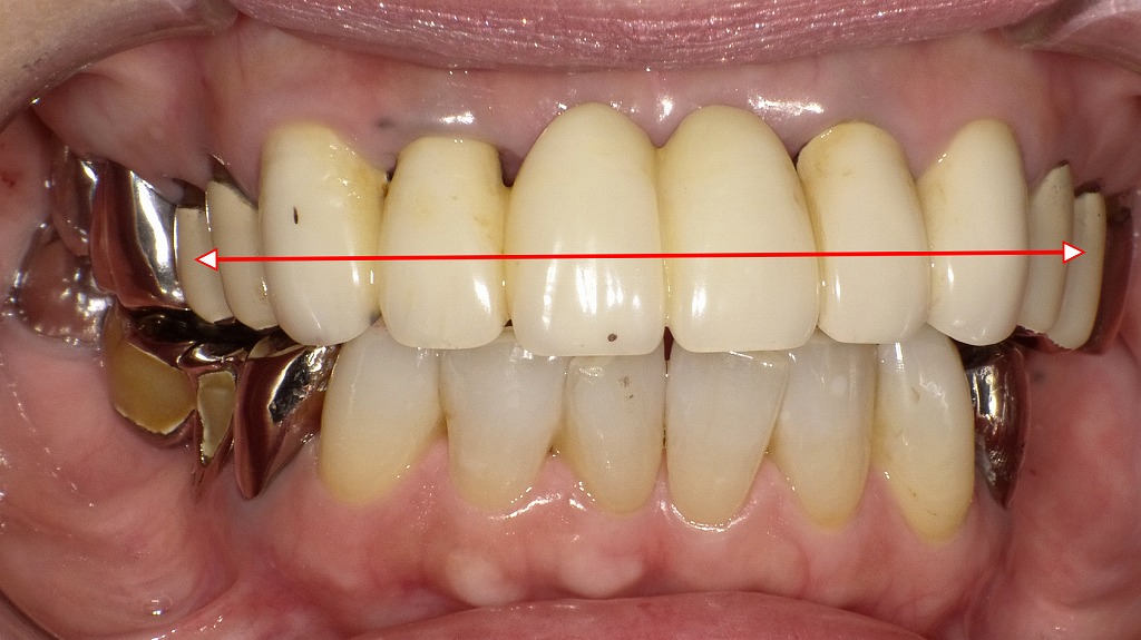 保険適用の被せ物の症例：正面観