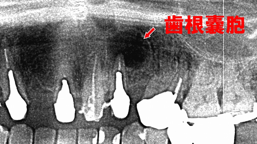 上顎左犬歯を原因とする歯根嚢胞
