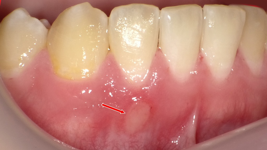 前歯の歯肉に発生した白い口内炎