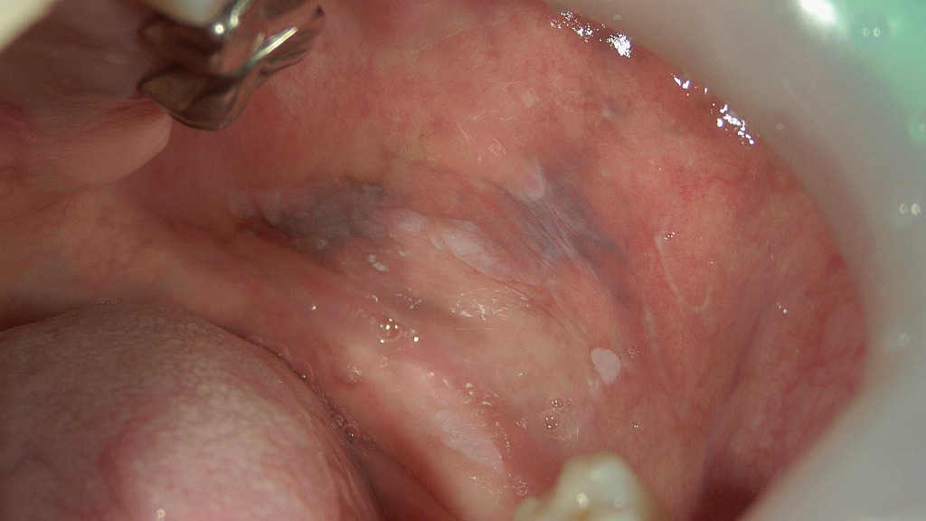 頬粘膜に網目状の白斑がみられる典型的な口腔扁平苔癬の所見。炎症により粘膜が荒れ、違和感やヒリつきを伴うことがあります。