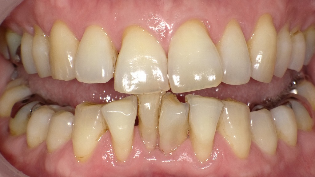 ホワイトニング前（1枚目）