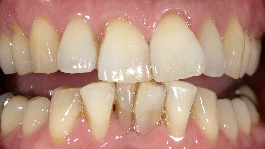 ホワイトニング後（2枚目）