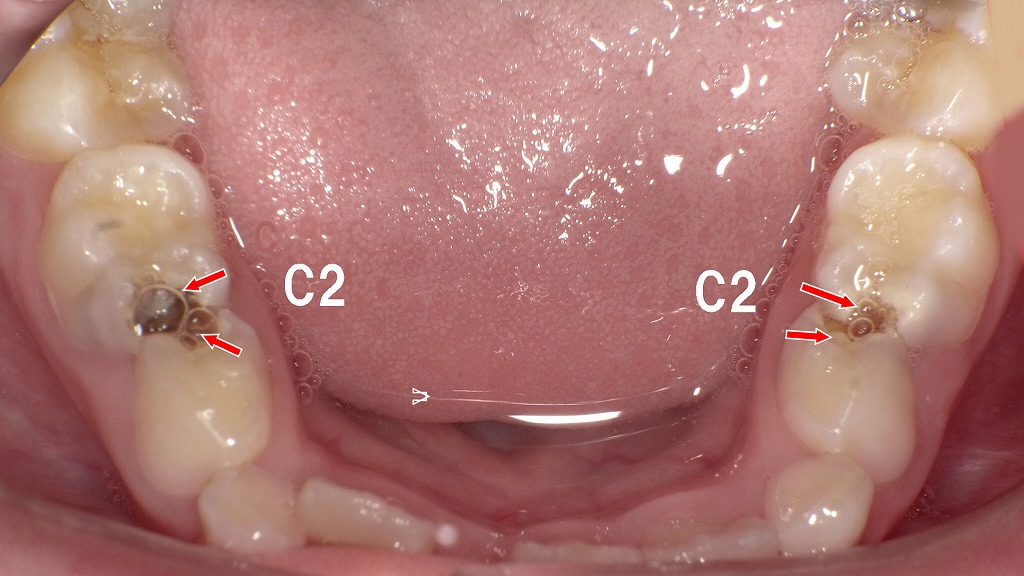 左右の乳歯にC2虫歯
