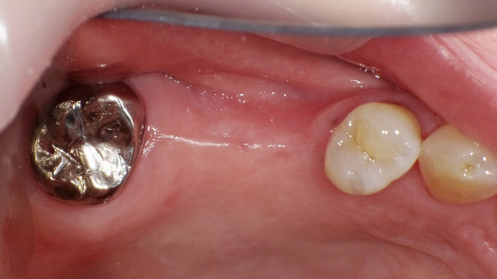 骨吸収が進んだ部位へのインプラント治療