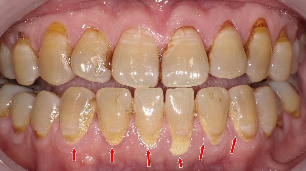 縁上歯石の多発例：正面観