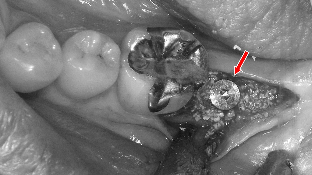 下顎7番抜歯後のインプラント埋入と上顎7番挺出への対策