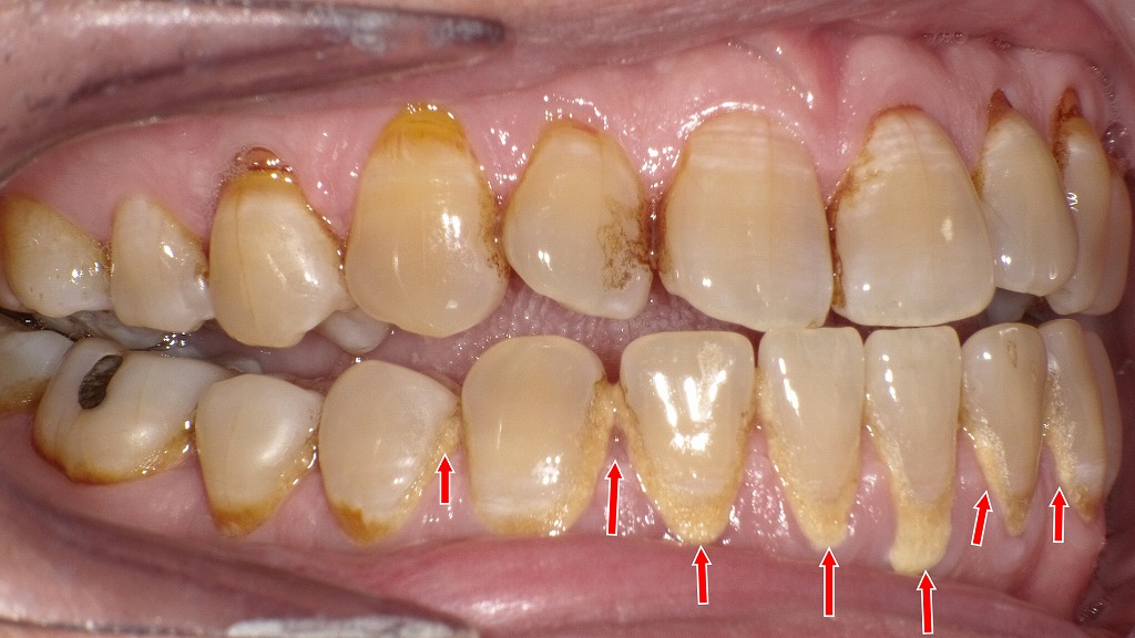 縁上歯石の多発例：右側面観
