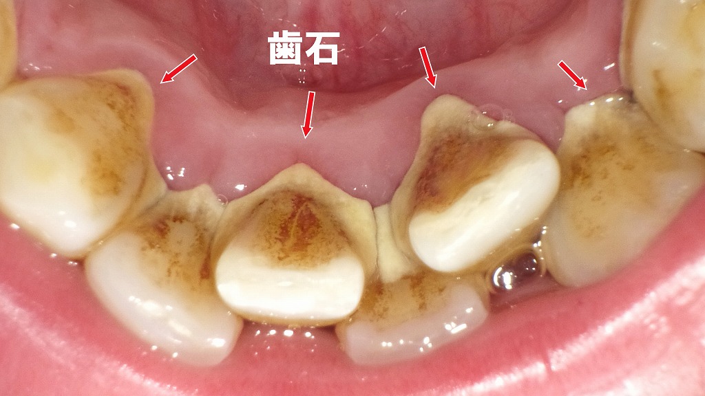 舌側にびっしり付着した歯石は歯周病を急速に進める原因に