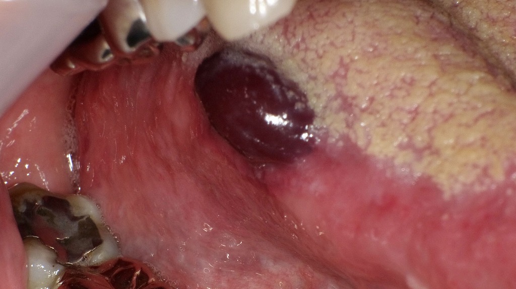 舌にできた血豆(口腔内血腫)