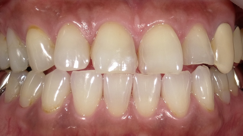 After：透明感のある白さにトーンアップし、笑顔の印象が一気に明るく✨