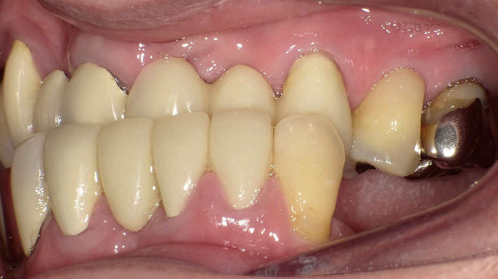 横顔がきれいに見えにくくなる原因｜受け口（反対咬合）の影響