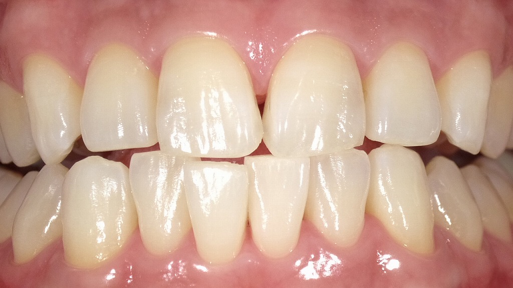 2枚目：ホワイトニング後