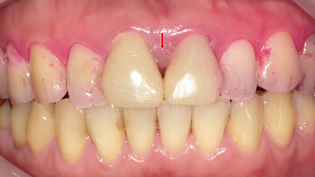 歯ぐきはほぼ正常に回復。染め出し液で清掃状態も良好