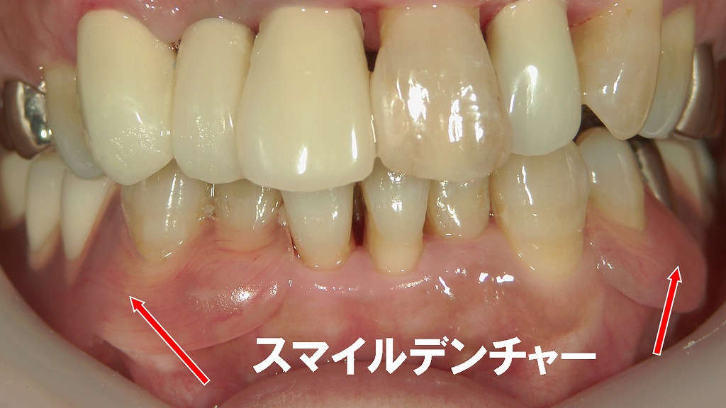 下顎左右の欠損部に、金具が見えない審美タイプの部分入れ歯「スマイルデンチャー」を装着した症例です。