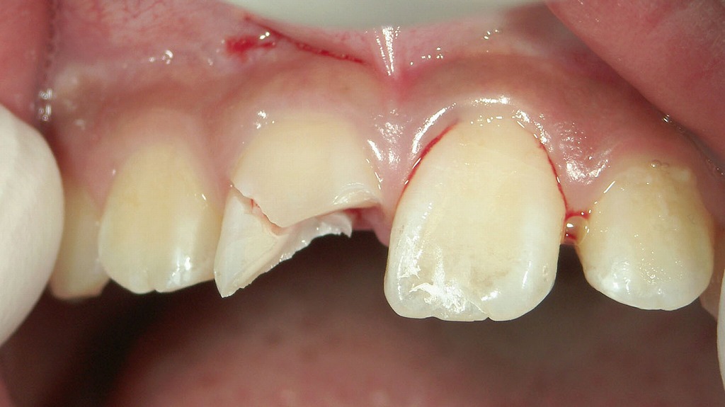 歯が折れて神経が露出した状態（前方面）