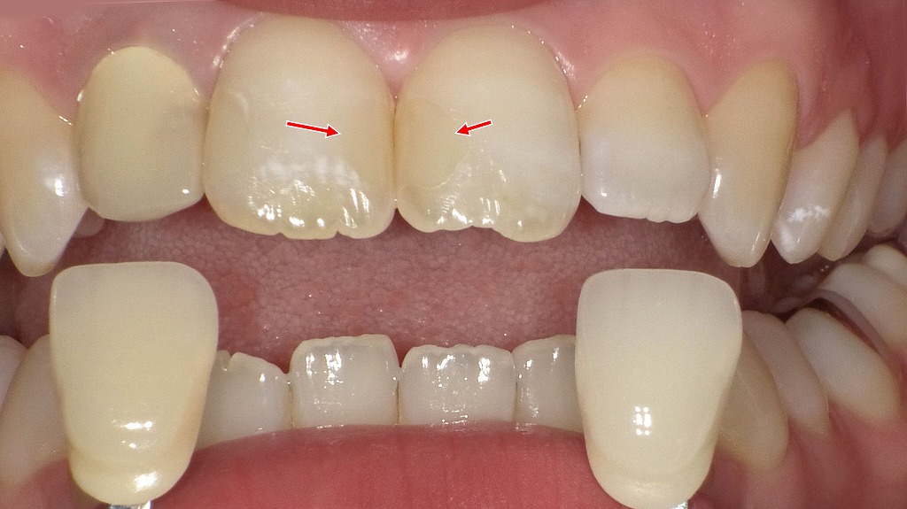 上顎1・1番の中等度虫歯｜コンポジットレジン修復とシェードガイドによる色調選択