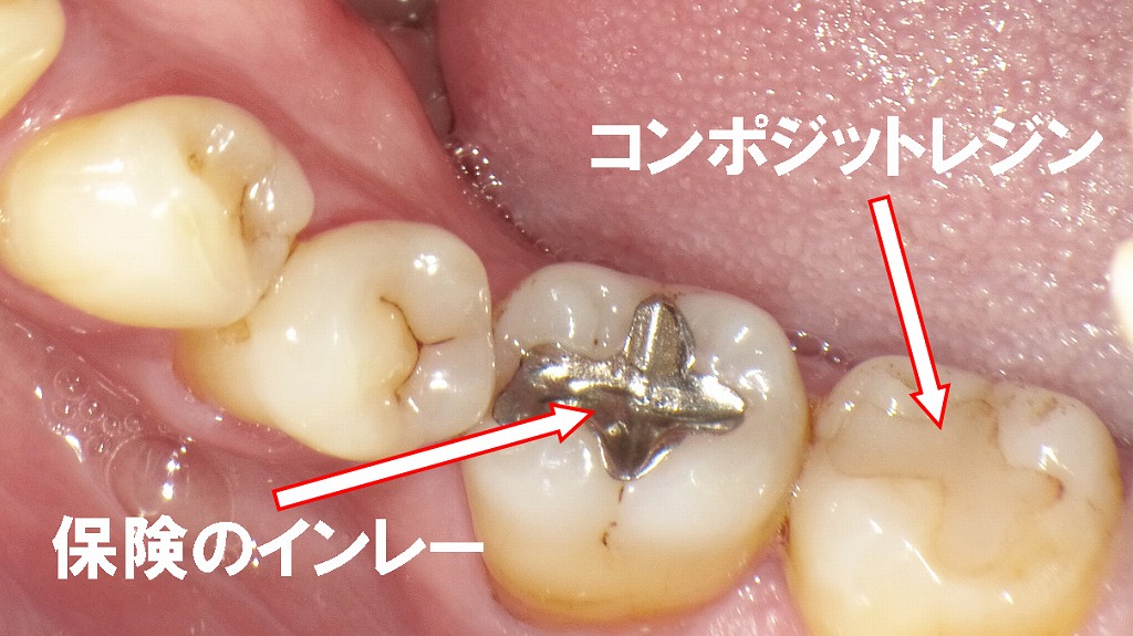 保険適用の詰め物（メタルインレー、コンポジットレジン充填）