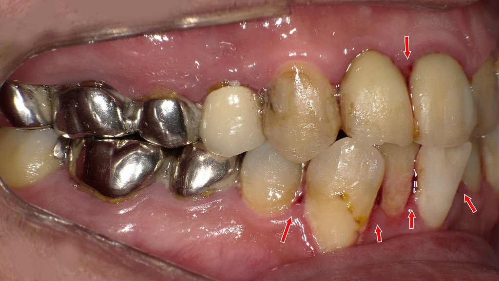 歯周病で歯ぐきが自然に出血する状態とは｜進行した炎症のサイン