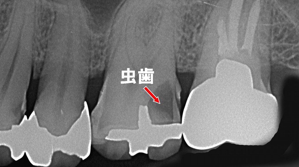銀歯の寿命と“すき間むし歯”