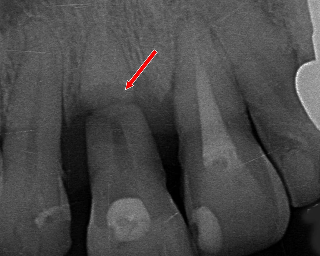 歯根まで達する破折：抜歯が必要な歯の根の折れ方