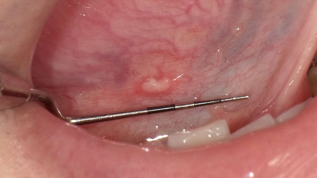舌の裏に生じたアフタ性口内炎