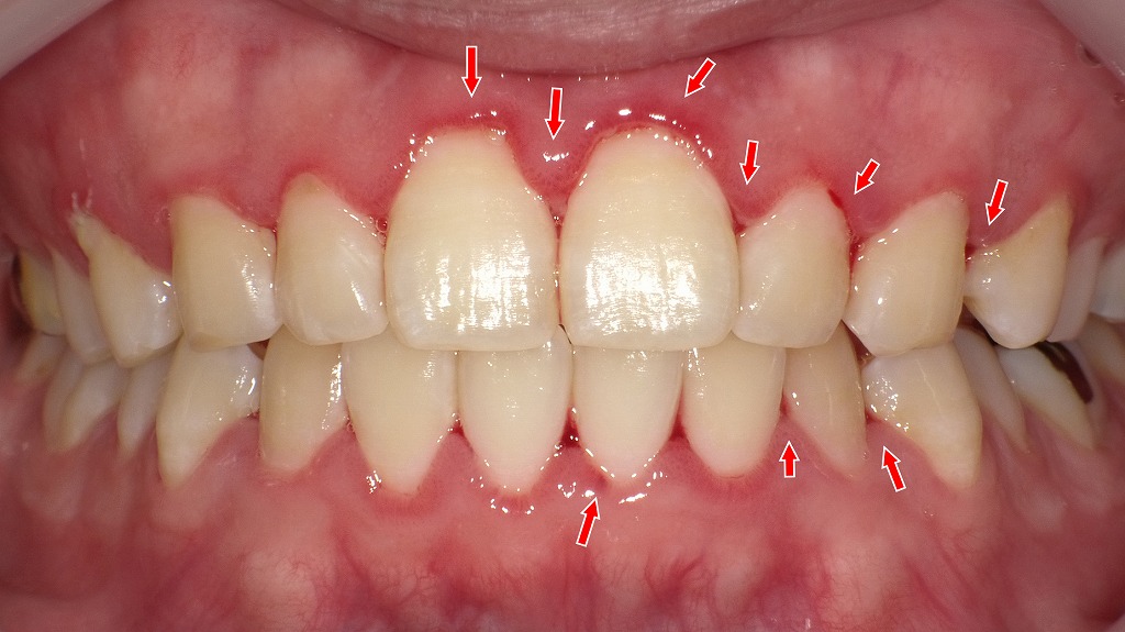 歯ぐきの腫れと出血のサイン:歯肉炎の典型的な所見
